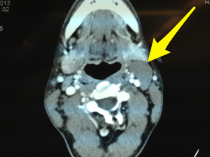 CT scan image of a branchial cleft cyst