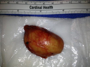 Resected branchial cleft cyst