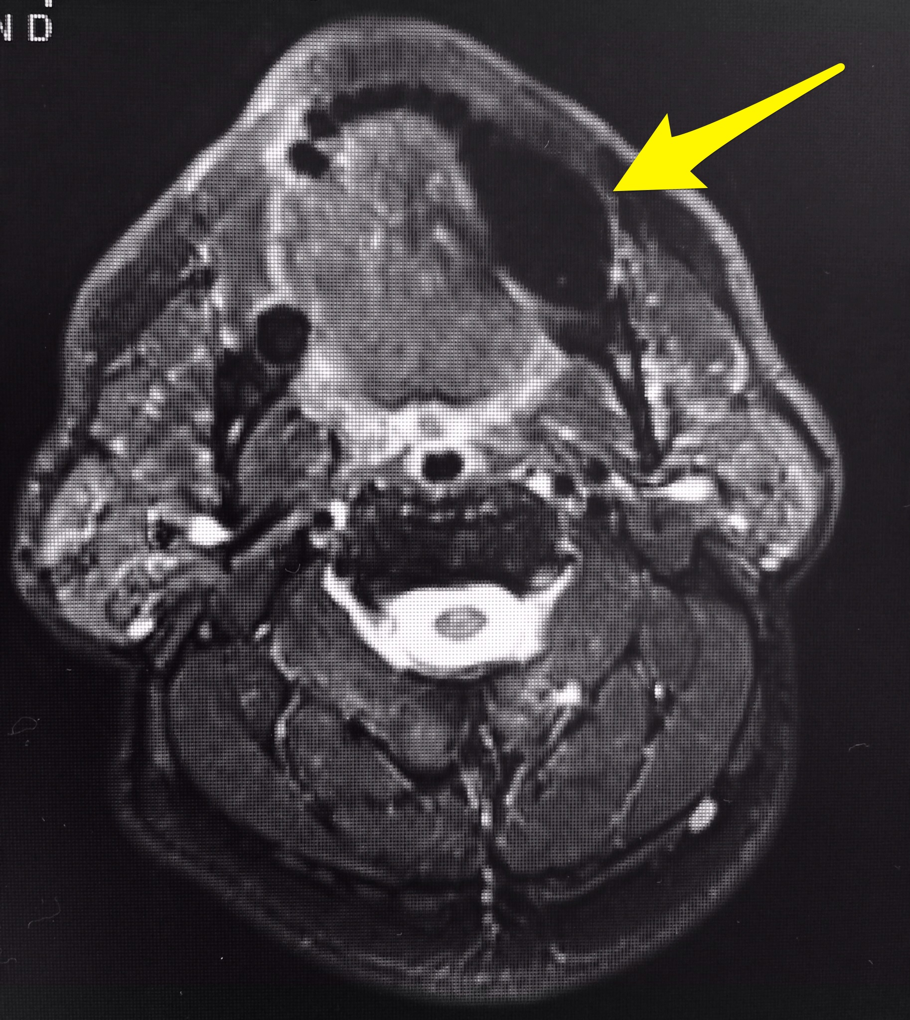 MRI image of a lipoma under the mandible (jawbone)